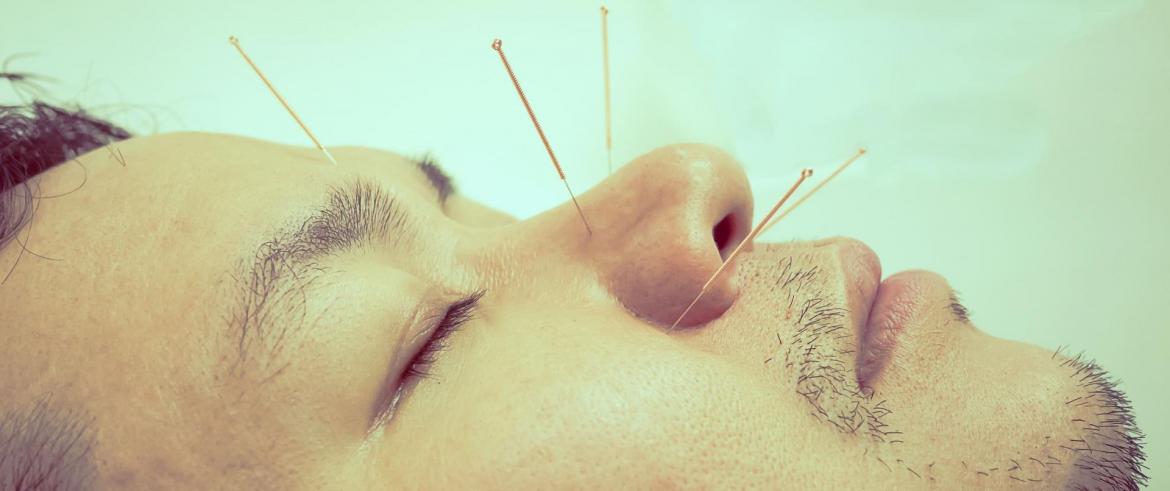 Acupuncture A Arlon Bastogne Neufchateau Lombalgie Migraine Stress